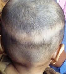 Often, children lose hair because of a scalp disorder. Three Month Old Infant With Band Like Hair Loss On The Occiput Archives Of Disease In Childhood