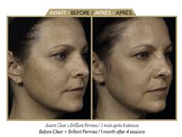 Dr Natalie Keller-cryolipolyse