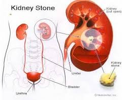 See more of penawar semulajadi buah pinggang rosak on facebook. Coway Sebab Buah Pinggang Rosak 11 Faktor Yang Facebook