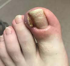 We did not find results for: Ingrown Toenail Causes How To Treat And Fix Infected Ingrown Toenail