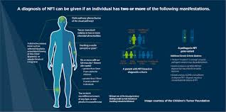In some cases, an affected person inherits the mutation from an affected parent. Revised Diagnostic Criteria For Neurofibromatosis Type 1 And Legius Syndrome An International Consensus Recommendation Genetics In Medicine