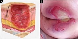 Pressure injury: update on general concepts, clinical aspects, and  laboratory findings – Part I | Anais Brasileiros de Dermatologia