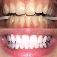 We did not find results for: How To Get Whiter Teeth Dr Karen Kassabian