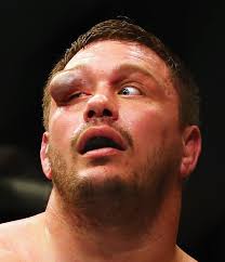 What are your Top 3 Worst Injuries in UFC History?