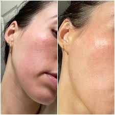 Image result for contact dermatitis
