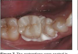 Do not use h 2o 2, edta or na 2co 3. Predictable Cementation For Monolithic Zirconia Crowns Semantic Scholar