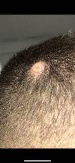 Merkwurdige Stelle Am Kopf Beule Beule Am Kopf