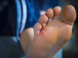 Soigner les crevasses aux mains | remède de grand mère  santé . Les Astuces Naturelles Pour En Finir Avec Les Cors Aux Pieds