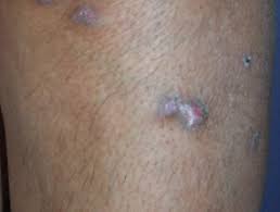 Dermnet.com › browse categories › psoriasis pictures, lichen planus and related diseases › lichen planus hypertrophic (page 1) lichen planus hypertrophic photos. Lichen Planus Dermnet Nz