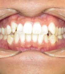 Tooth overcrowding can sometimes be fixed with braces, but those who do not want to commit to braces have other options to fix crowded teeth without if you have this condition, the following information can be helpful as you seek to correct the problem. Crowding Of The Teeth Orthodontist Ottawa On Centrepointe Orthodontics