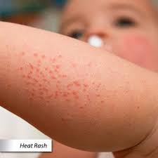 Red, blotchy rash, with target like hives or sores. Skin Rash Covid 19 Types Causes Treatment Prevention