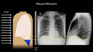 Maybe you would like to learn more about one of these? How To Interpret A Chest X Ray Lesson 6 Diaphragm And Pleura Youtube