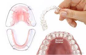 Be sure that you wash your retainer once you remove it from your mouth while it is still moist. How To Properly Clean Orthodontic Retainers