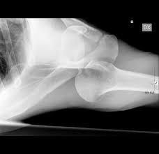 Image result for Shoulder Dislocation