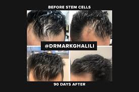 The clinics that currently offer stem cell hair therapies not approved by the fda don't make any guarantees in regard to. Hair Loss Hair Loss Treatment Regenerative Medicine La