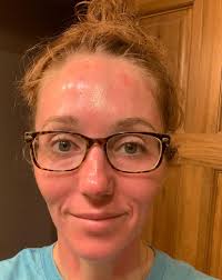 microneedling ...who else LOVES the after feel of a good microneedling  session?! If you're like my sister, she says it looks like ones been in a  bar fight after 😝 I'll take