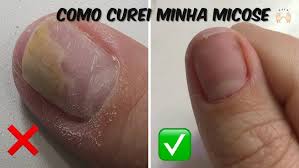 A condição médica pela qual aparecem riscos escuros (do marrom escuro ao preto) nas unhas é conhecida micose: Micose Nas Unhas Causas Sintomas E Tratamento Youtube