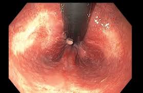 Image result for hemoroid human