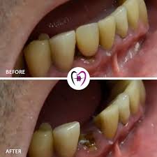 Image result for Tooth Extraction