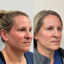 BBL Laser in Marlton