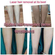 It is a safe method used by thousands of people to remove and slow unwanted hair growth. Facebook