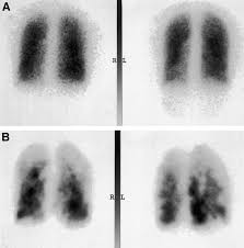 Image result for Ventilation Perfusion Scan