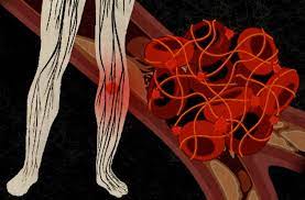 Although initially appearing as distinct entities, lung cancer is a great risk factor for the development of pe. Blood Clots What Cancer Patients Need To Know