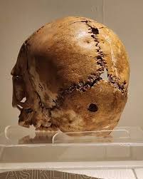 Image result for Skull Trephination