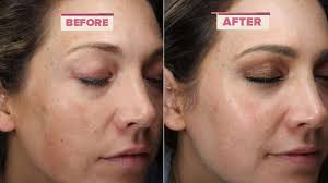 Image result for Melasma
