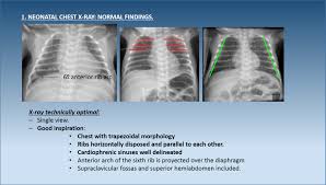 2 types of c hest films pa routine cxr taken at a greater distance than ap to give better clarity and less 12 respiratory distre ess syndrome (rds) definition: Epos