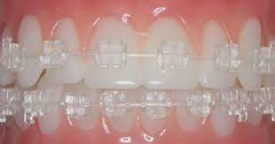 Dentaltown Where The Dental Community Lives Braces Colors Ceramic Braces Clear Braces
