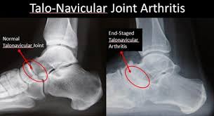 The doctor check the xray and told me that the bones are not totally joined yet and it will take more 15 days. Rheumatoid Arthritis Talonavicular Joint Footeducation
