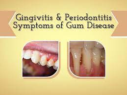 The Longer Plaque And Tartar Are On Teeth The More Harmful They Become The Bacteria Cause Inflammation Of The Gums T Gum Disease Periodontitis Receeding Gums