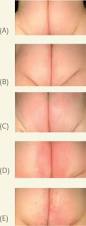 Image result for diaper dermatitis