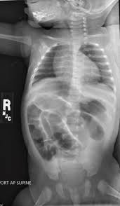 Image result for Intussusception