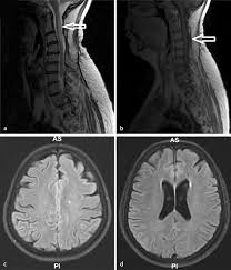 Krankheitsschübe wie auch läsionen in der magnetresonanztomographie (mrt) reflektieren den krankheitsprozess bei der… teriflunomid reduziert den jährlichen verlust an hirnvolumen frankfurt, 02. Abb 1 8 A Langstreckige Zervikale Myelitis Von Hohe Der Download Scientific Diagram