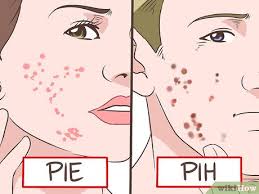 #3 cara hilangkan parut dengan lidah buaya. 3 Cara Untuk Menghilangkan Parut Dan Luka Bekas Jerawat Wikihow