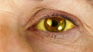 Herpes, eksim, panu, kanker melanoma dan lainnya. 10 Obat Tradisional Penyakit Kuning Yang Ampuh Gunakan Bahan Alami Hot Liputan6 Com