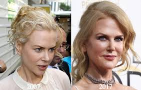 Nicole Kidman Plastic Surgery