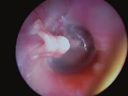 Image result for Ossicular Chain Disruption