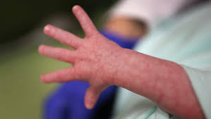 You may even notice peeling. Babies Born With Heroin Dependency