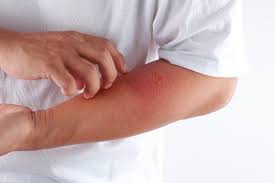 Solutions Naturelles Pour Soigner L Eczema En 2020 Eczema Soigner Eczema Base De Plantes