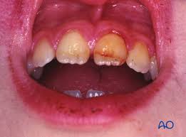 Image result for Tooth Luxation
