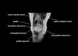 David rubin and robin smithuis. Knee Anatomy Mri Knee Coronal Anatomy Free Cross Sectional Anatomy Knee Anatomy Knee Mri Anatomy