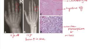 Ollier Disease And Maffucci Syndrome Youtube