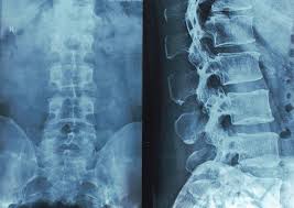 Image result for Spinal Trauma