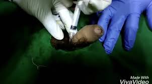 Local anesthetic for circumcision - ThisVid.com