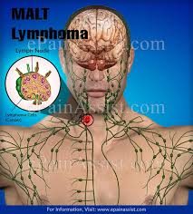 Lymph nodes in the neck. Malt Lymphoma Causes Symptoms Treatment Diagnosis