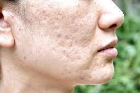 After cleansing, gently apply the mixture to the skin using a cotton ball. How To Get Rid Of Acne Scars Treatments And Home Remedies