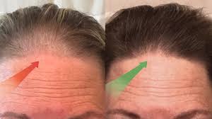 Did you know that hair falls under the purview of your dermatologist? 17 Best Foods To Stop Hair Loss Dermatologist Proven These Diets Must Be Followed Youtube